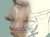 Žigotični proces gornje čeljusti
