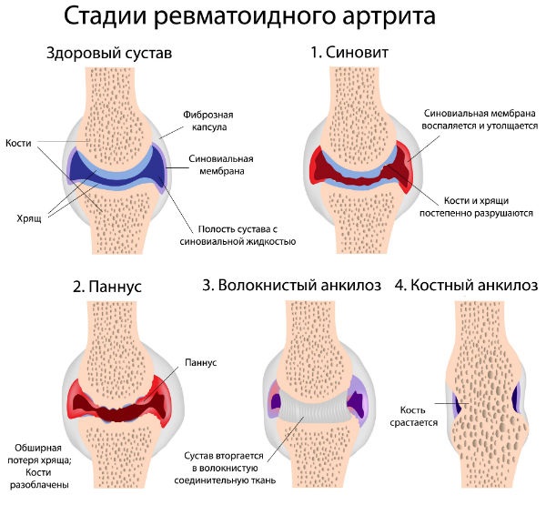 a lábak kis ízületeinek deformáló artrózisa