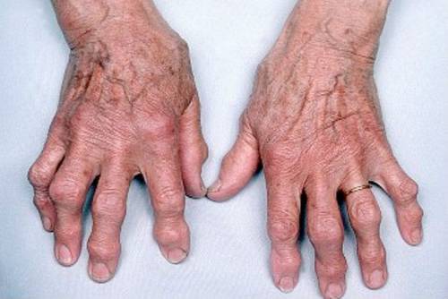 a kezek ízületeinek szinovitisz kezelése)