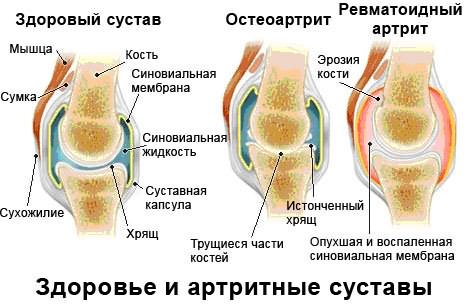 artroza carpică metacarpală)