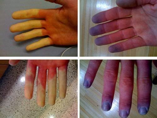 traumatism al articulației metacarpofangaliene a degetului arătător
