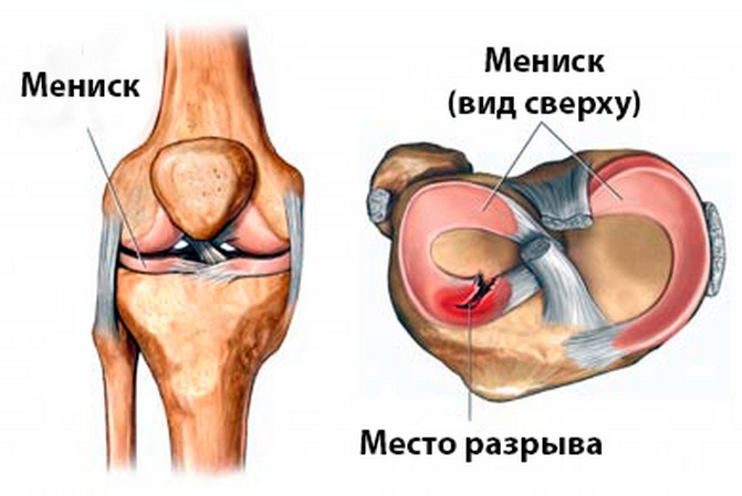 deteriorarea degenerativă a meniscului intern al genunchiului