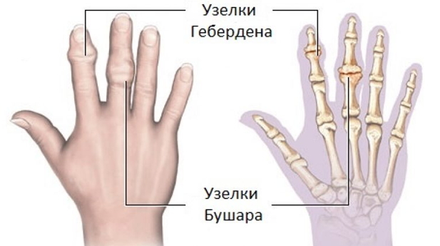 articulațiile degetelor doare și apar denivelări)