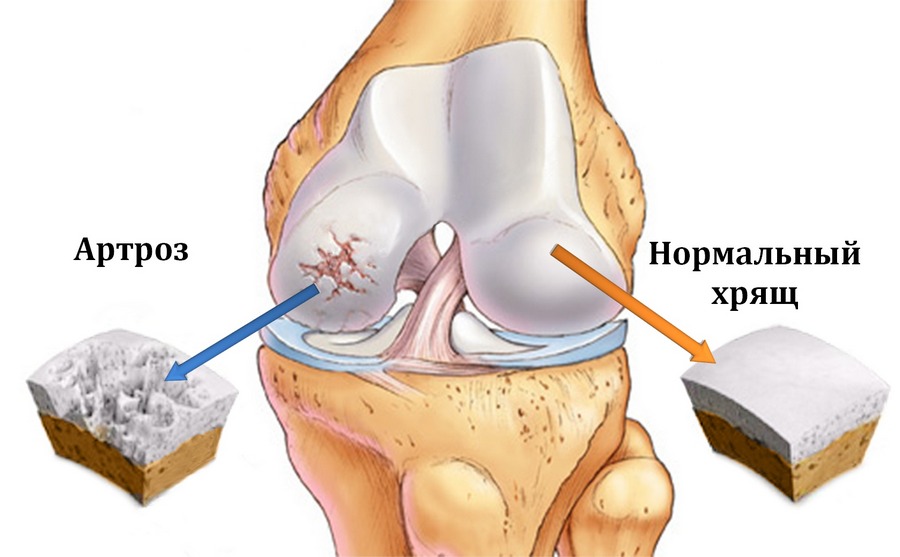 De ce rănesc articulațiile la genunchi