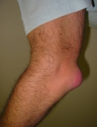 articulația inflamată pe tratamentul brațului