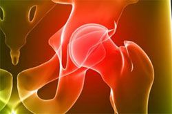 2. fokozatú deformáló artritisz a csípőízületen