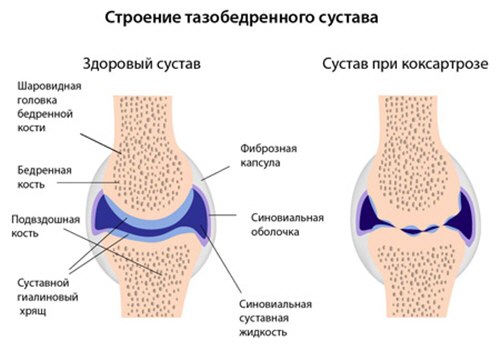 artroza deformării articulației șoldului 2 grade)