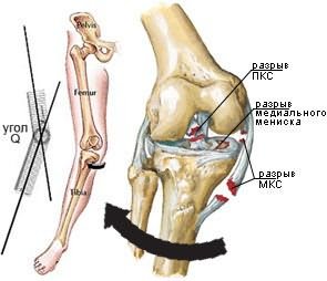 vesszők a térd artrózisához kenőcs a lábak csontritkulásáért