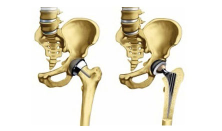 a csípőízület deformáló artrózisának stádiuma az artrózis kvh terápiás kezelése