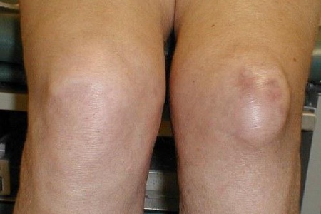 cum se tratează edemul articulației genunchiului)