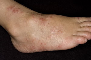 A lábak bőrén a vörös foltok okai és a kezelési módok
