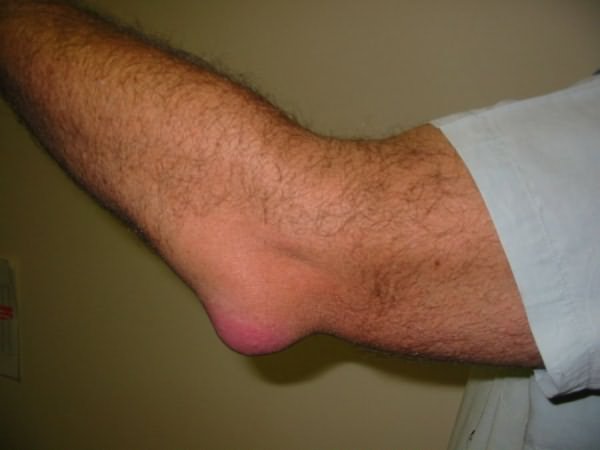 ce inseamna artroza la picioare medicamente bune pentru artrita