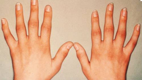 a kefe kis ízületeinek csontritkulása nagy ízületi rheumatoid arthritis