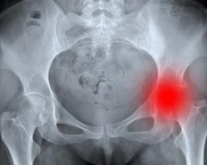 miért használhatatlanok a chondroprotektorok az artrózis kezelésében váll osteoporosis kezelés