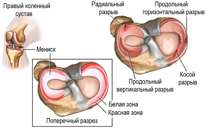 Deteriorarea cornului meniscului genunchiului