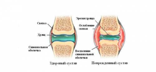 kortikoszteroidok a vállízület artrózisához