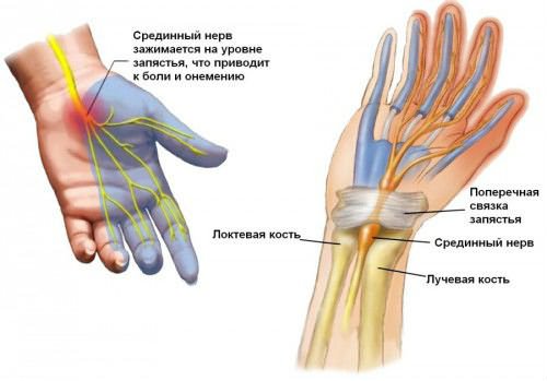 cum este tratată artrita genunchiului