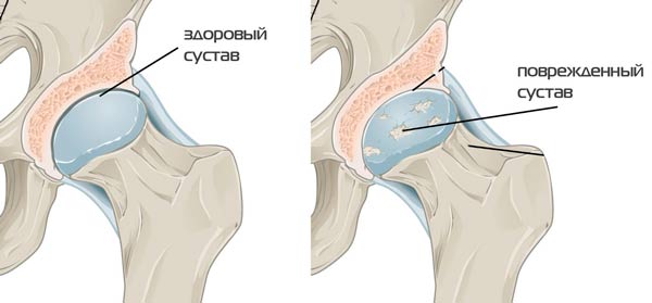 deformáló artrózis a csípőízületek 2-3 fokú