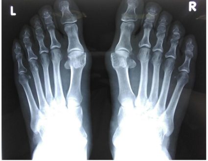 a nagy lábujj ízületének osteoarthrosis kezelése