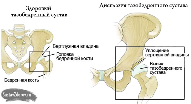 hogyan lehet azonosítani a csípőízület artrózisát