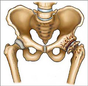 a csípőízület deformáló artrózisának mértéke