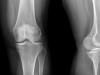 Príčiny bolesti kolena