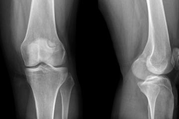 Przyczyny bólu kolana