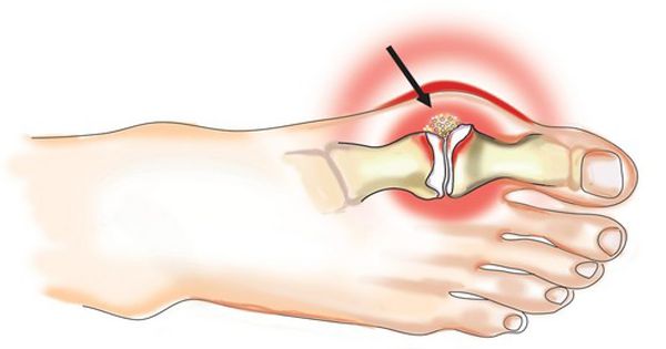 a bal csuklóízület deformáló artrózisa