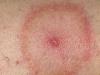 Lyme disease - tick-borne borreliosis: symptoms and treatment