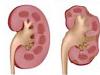 Symptoms and clinical manifestations of pyelonephritis