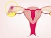 Čo spôsobuje špinenie týždeň pred menštruáciou Krvavé vločky 10 dní pred menštruáciou