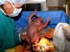נשיאת הריון עם שבר בעצמות האגן מחלות נוספות מהקבוצה הריון, לידה והתקופה שלאחר הלידה