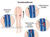 Five types of embolism, symptoms, diagnosis and treatment of pathology