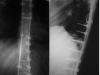 טיפול בעקמת של עמוד השדרה החזי