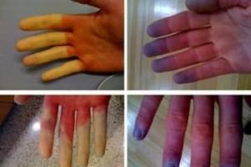 Kĺby na prstoch bolia - čo robiť?