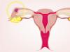 Prítomnosť krvavého výtoku pred menštruáciou: príznaky patológie 10 dní pred menštruáciou, krvavý výtok