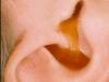 Preťaženie uší bez bolesti: príčiny, príznaky a vlastnosti liečby Prečo upchatie uší po