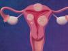 הפרשות חומות בהריון - תופעה מסוכנת הפרשות חומות לפני לידה לאחר בדיקה