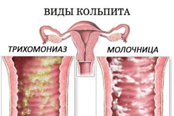 Kolpitída (vaginitída): čo to je, príčiny, symptómy a liečba
