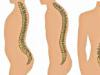 Types of curvatures and deformities of the spine